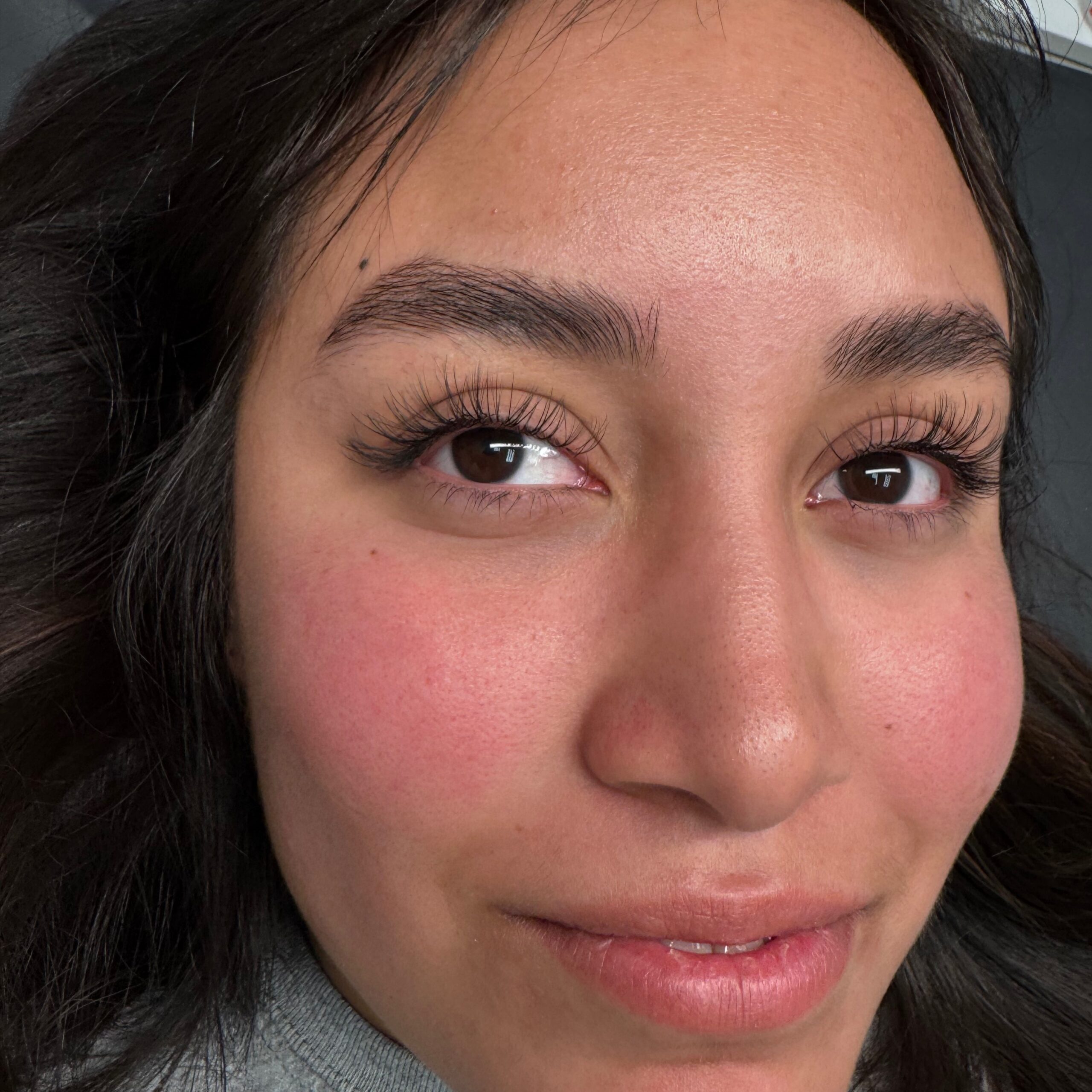 Classic Fill at Ashley York Aesthetics, Peoria AZ